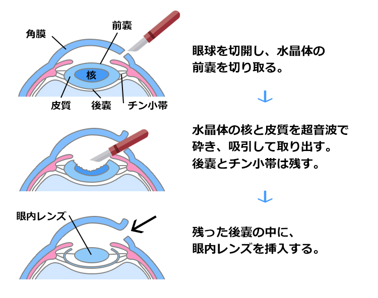 白内障手術