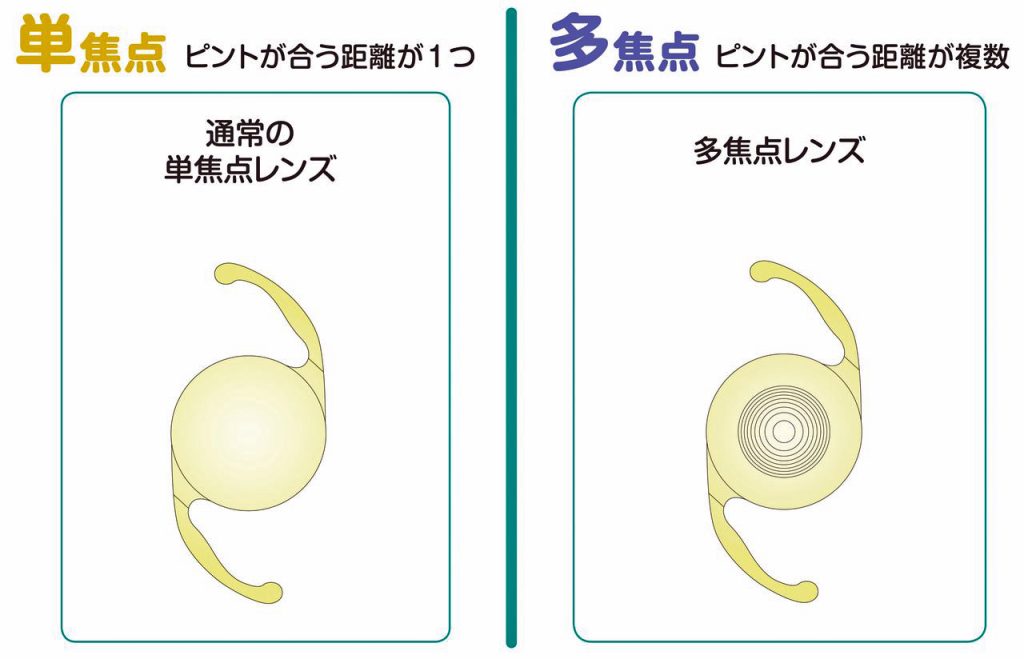 眼内レンズの違い